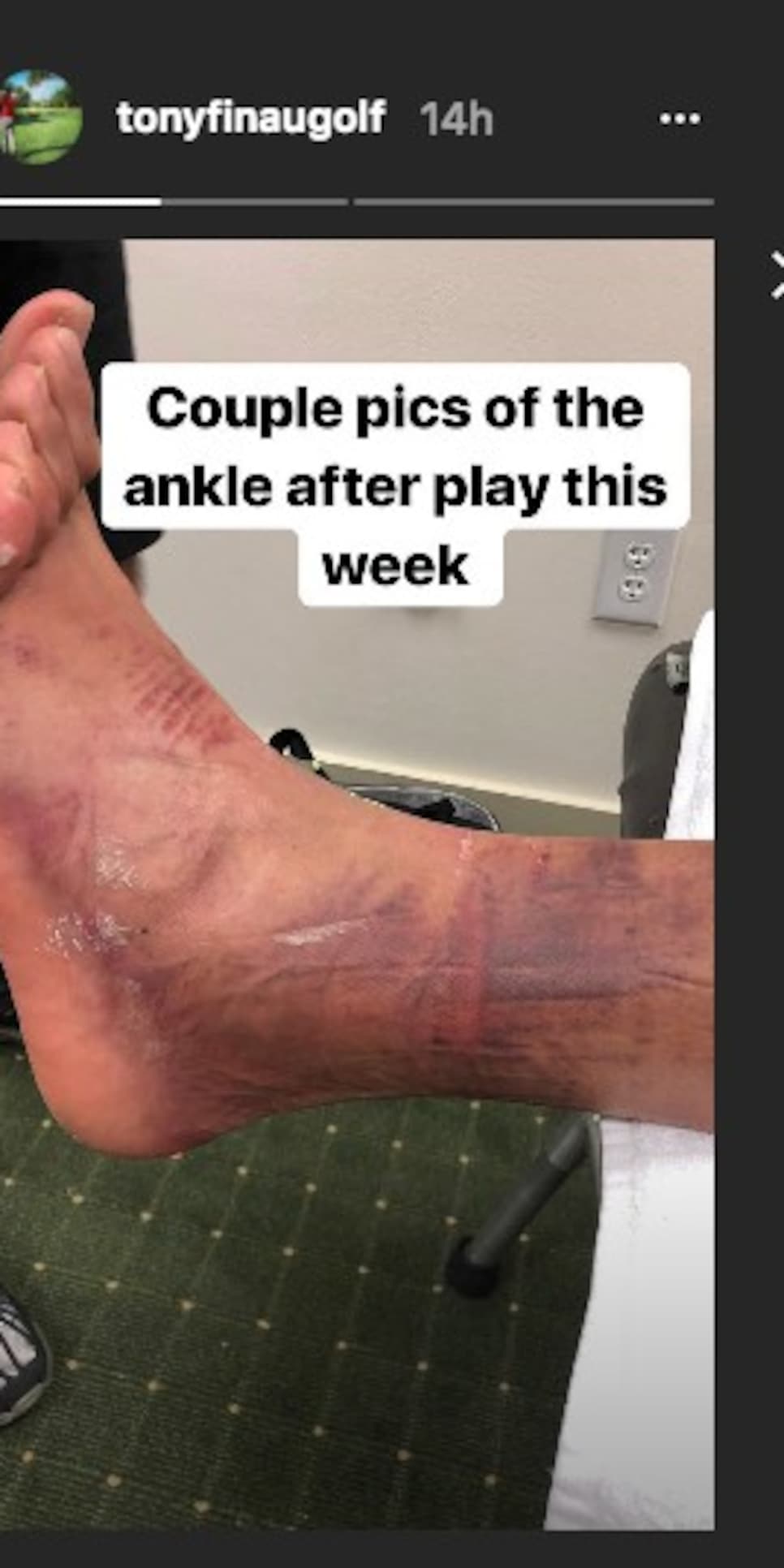 Tony Finau Has A Different Definition Of My Ankle Is Fine Than Everyone Else In The World 
